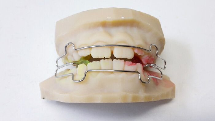 Zhotovení ortodontických aparátů na 3D tištěné modely