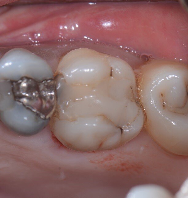 Figg. 1a, 1b - Elemento dentale n. 16 che necessita l’estrazione.