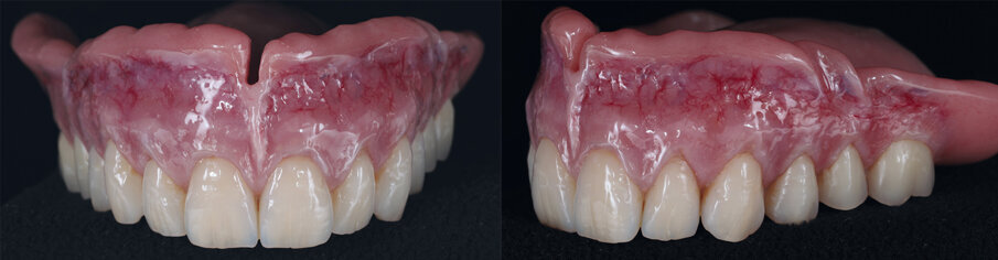Figs: 7 and 8. The completed upper denture distinguishes itself through its characterizations with gingival composite and phonetically aligned teeth.