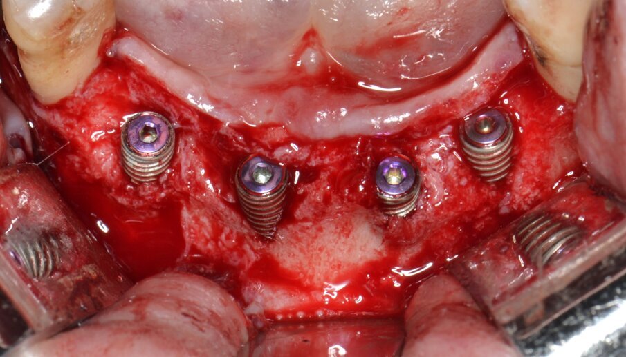 Fig. 7 - Inserimento di 4 impianti endossei: una consistente porzione della superficie attiva rimane esposta.