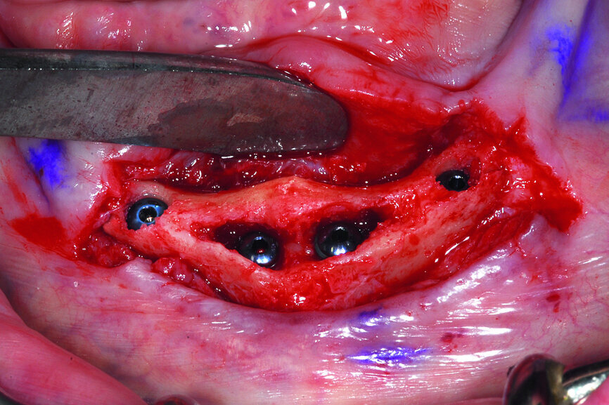 Fig. 16b: The thread design of
the AnyRidge implant (a),
four implants well-fixated in the
mandibular symphysis (b).