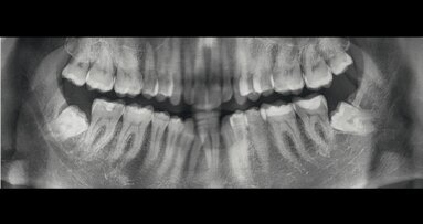 Un caso di IIa Classe con morso aperto e mancanza dell’incisivo centrale destro inferiore, trattato ortodonticamente con un trattamento ibrido con allineatori