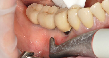 Prévention 0 : La meilleure façon de prévenir la péri-implantite ?