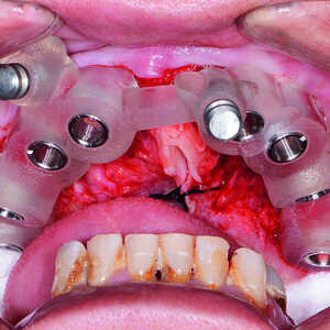 Fig-9-Mise-en-place-du-guide-chirurgical-maxillaire-300x300-