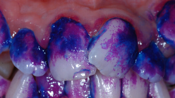 Nuove frontiere per la gestione della placca batterica: rivelatori di placca a confronto