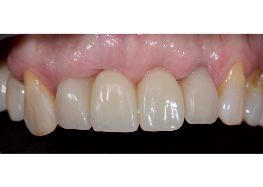 Fig. 66_Controllo del provvisorio ad 1 mese.