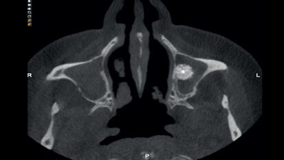 Complicaciones postoperatorias Complicaciones postoperatorias