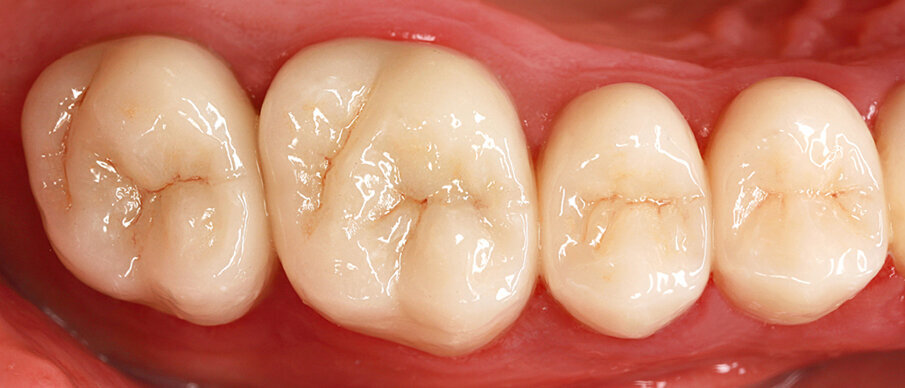 Fig. 9: Because of the critical conditions of the gums, the crowns (2007) are seated using a conventional cementation method with glass ionomer cement (Vivaglass CEM).