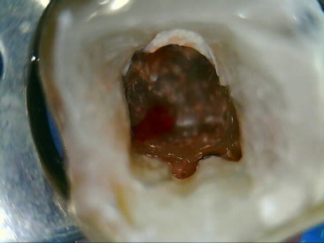 Fig. 2: Initial clinical and radiographic appearance of teeth 36