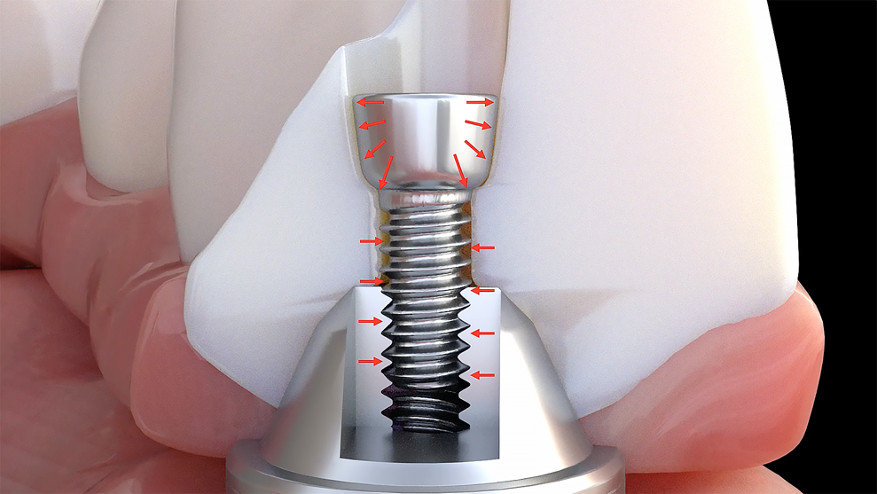 Fig. 9: Grammetry Vortex LA VIS screw attached directly to the multi-unit abutment, allowing for increased thickness of zirconia dependent on the available interocclusal space. (Image: Danny Domingue)