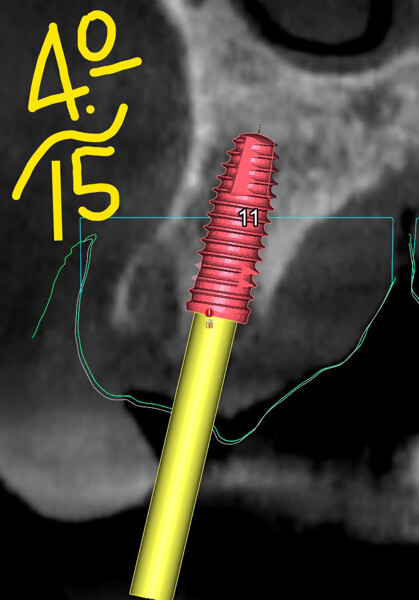Fig. 7e: Implant in position #23.