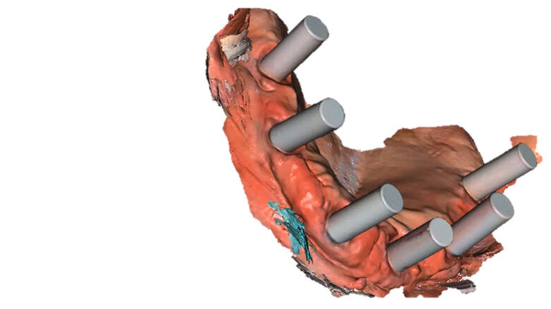 Software enhancements support a higher level of performance for Primescan and CEREC Primemill