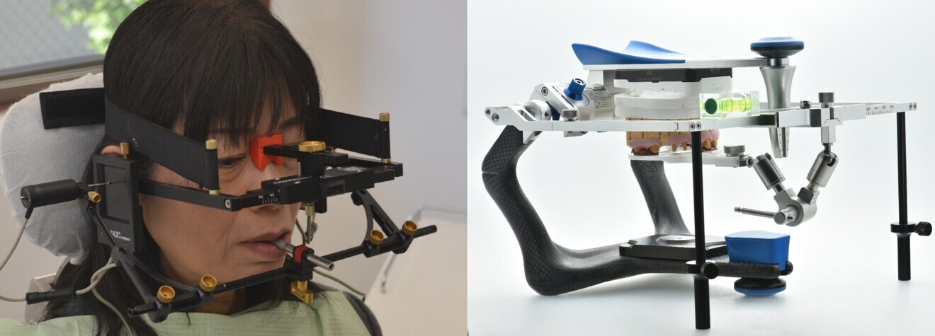 Figs. 3a & b: Extensive patient data was obtained using the facebow and transfer to the Artex CR.