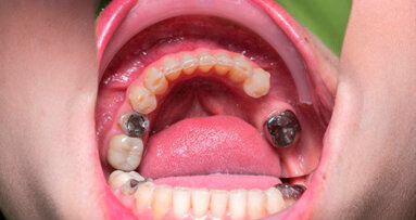 L’UE vieta l’amalgama nei bambini, nelle donne in gravidanza o durante l’allattamento