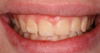 Riabilitazione estetica con resine composite in caso di severa Molar Incisor Hypoplasia: case report
