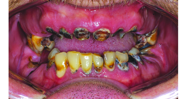 Complete reconstruction for a patient with chronic tooth decay