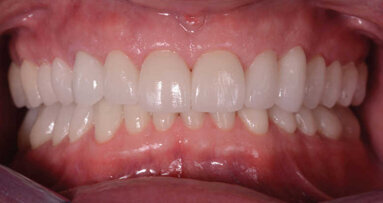 Correction de la dimension verticale d’occlusion : flux de travail numérique, scanner, CAD/CAM