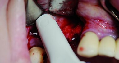 Augmentation osseuse – une base importante pour le concept du traitement implantaire