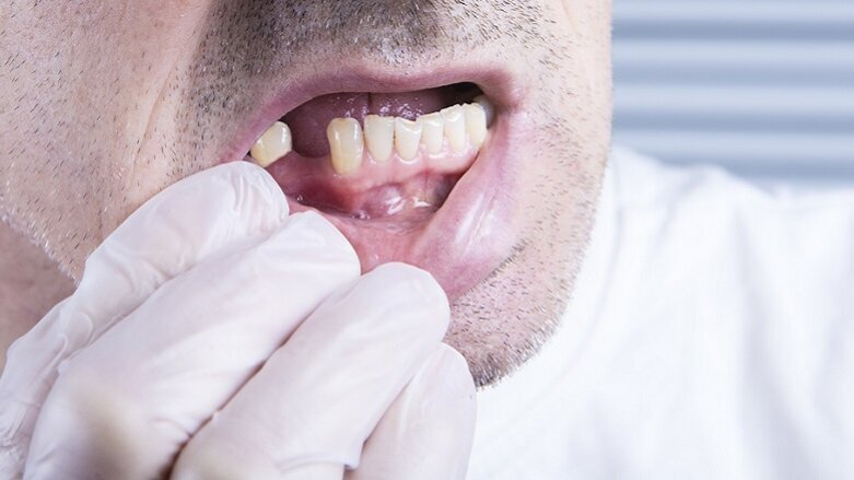 Middle-aged tooth loss linked to increased coronary heart disease risk