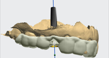 Clinical digital workflows for implant crowns