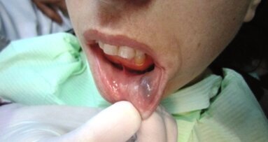 Leczenie naczyniowych schorzeń ust z zastosowaniem lasera