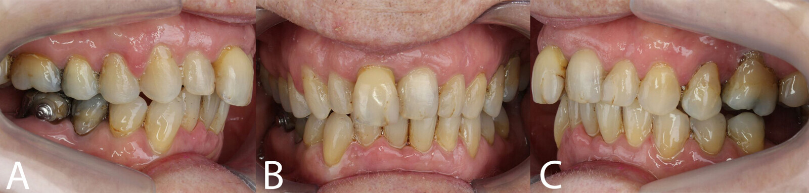 Figs. 2a–c: Intra-oral photographs. (a) Right lateral view. (b) Frontal view. (c) Left lateral view.