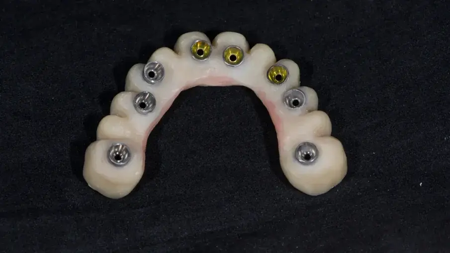 Фиг. 10: Временна протеза, подсилена с метал. 