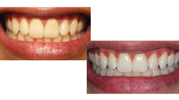 Aclaramiento en el consultorio de dientes vitales y no vitales