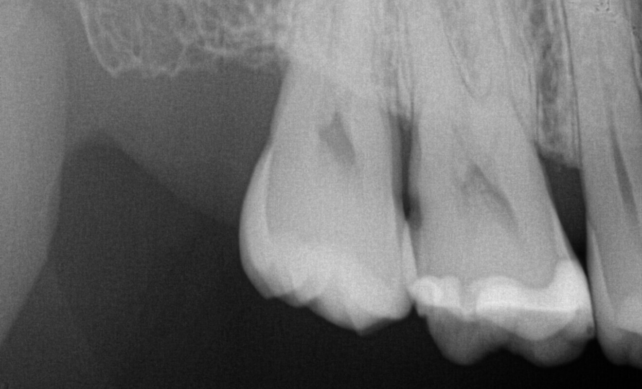 Fig. 3: Pre-op periapical radiograph demonstrating recurrent caries on the distal aspect of the maxillary right first molar.