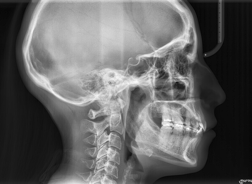 Fig. 10a: Final cephalometric radiograph and dental panoramic tomogram.