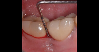 Perimplantite trattata con ozono stabilizzato in gel: case report