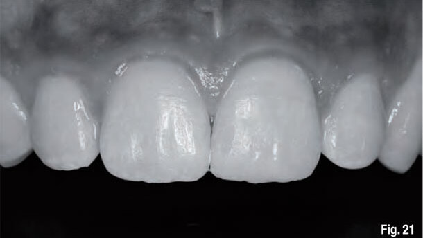 Anatomic stratification technique for lifelike anterior composites