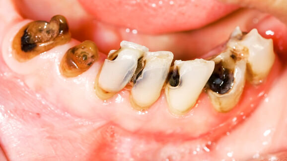 Billions to suffer from untreated tooth decay