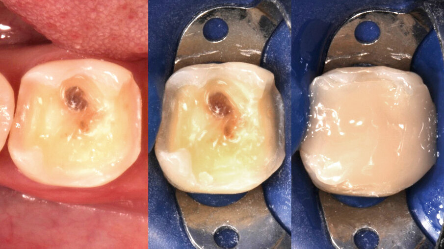 Fig. 3: Upon removal of the old filling, it becomes clear that a crown is needed to ensure the required stability. The tooth is built up with 3M™ Filtek™ Bulk Fill Posterior Restorative, which may be placed in conjunction with 3M™ Single Bond Universal Adhesive and in increments of up to 5 mm.