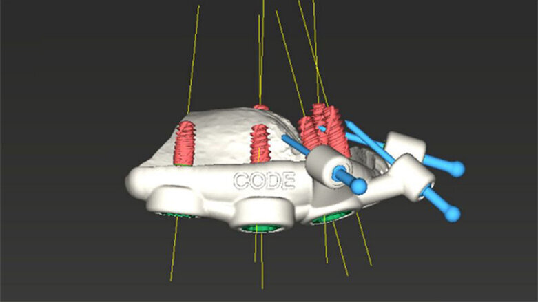 Celková rekonstrukce chrupu pomocí implantátů Straumann BLX a Pro Arch navigované chirurgie