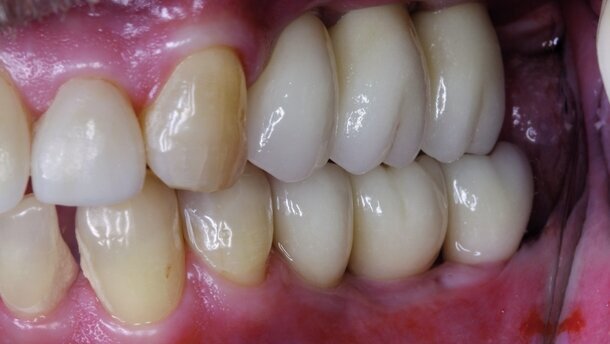 Terapia implantare in tutta sicurezza