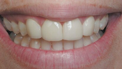 Έρχεται η «αναγέννηση» των δοντιών