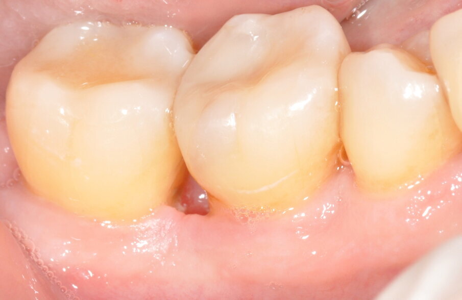 Fig. 13 - Rimozione sutura a 14 giorni.