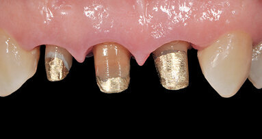 Mezi BOPT a BTA: Kazuistika zaměřená na tvarování gingiválního okraje kolem přirozených zubních pahýlů pomocí provizorních pryskyřičných korunek