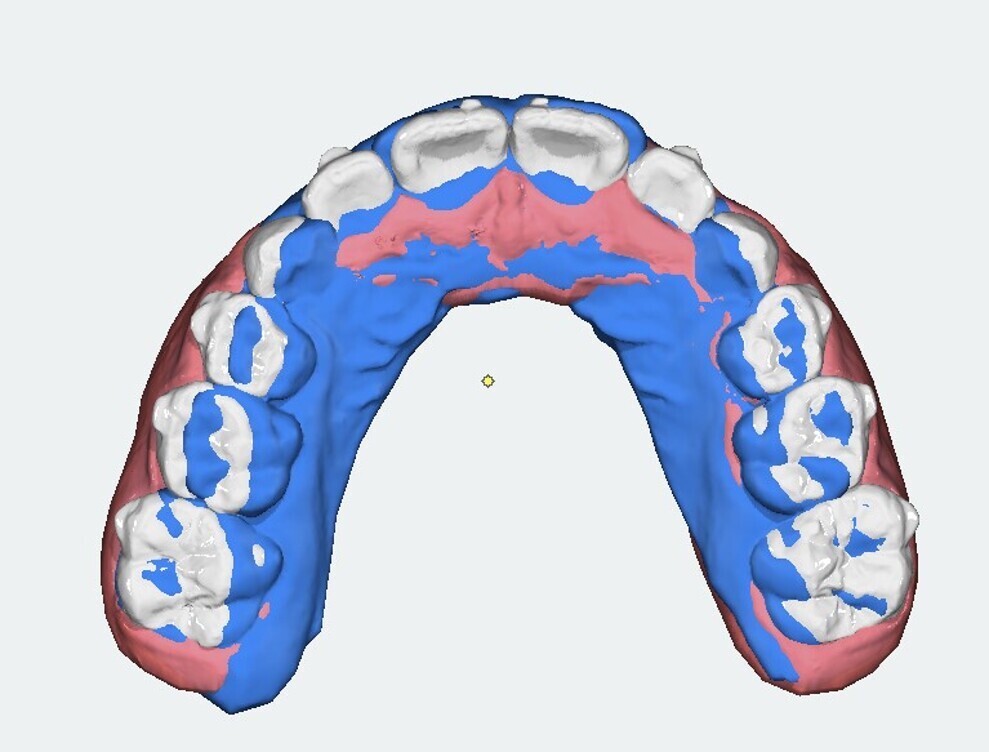 Fig. 13: OnyxCeph3 superimposition. Blue = initial arch shape and size.