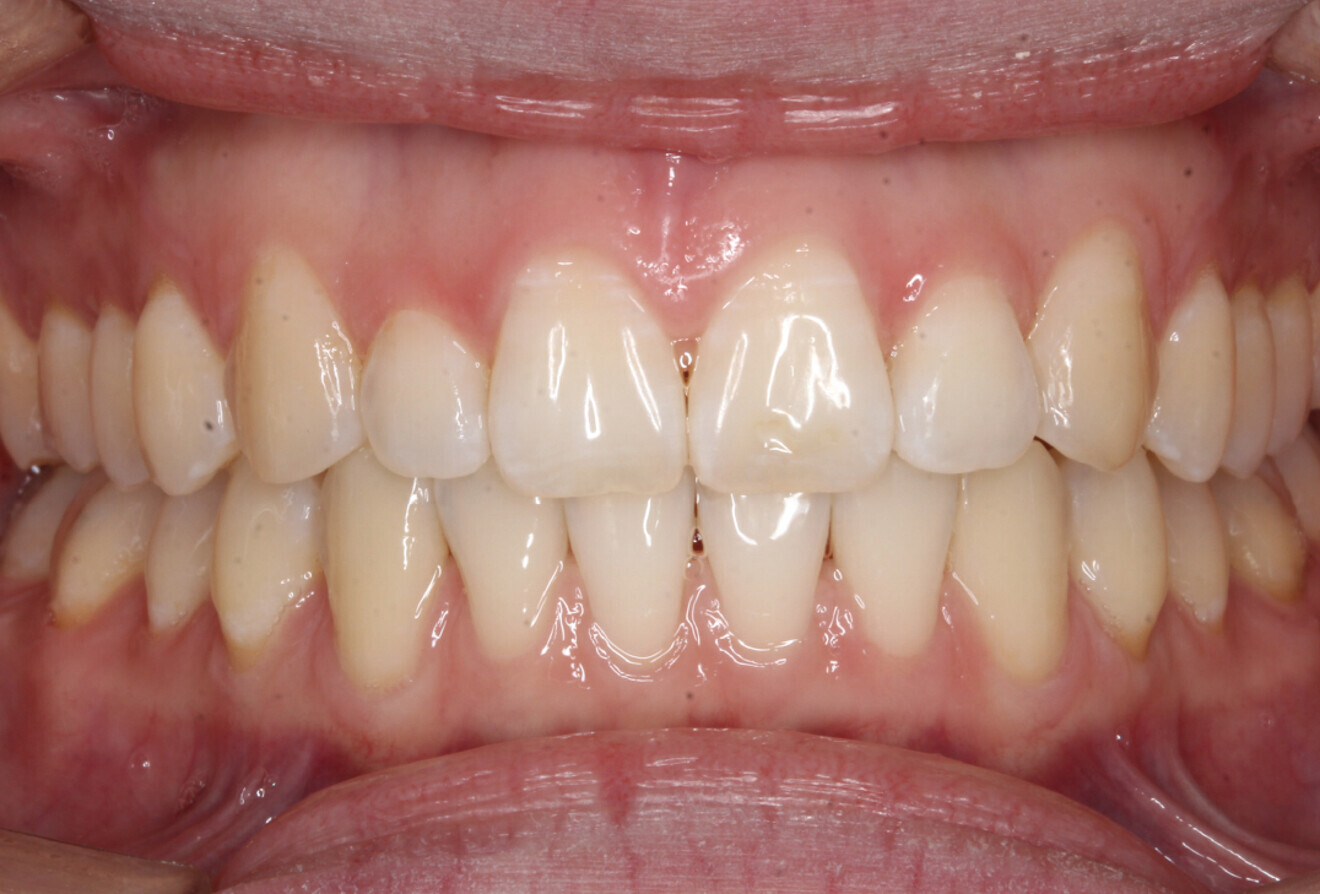 Fig. 4f: Frontal intra-oral view.