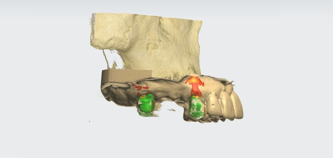 Fig. 2: Merging of the DICOM volume data set with the STL surface data set.