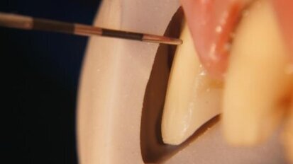 Ceramic and composite resin integration for custom smile design
