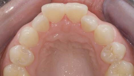 Inmam Aligner: Korigovanje položaja zuba, beljenje i izrada direktnih adhezivnih restauracija – progresivni pristup preoblikovanju izgleda osmeha (Drugi deo)