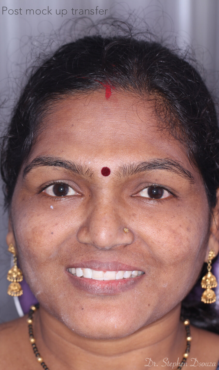 Fig. 7: Smile, post mockup transfer.