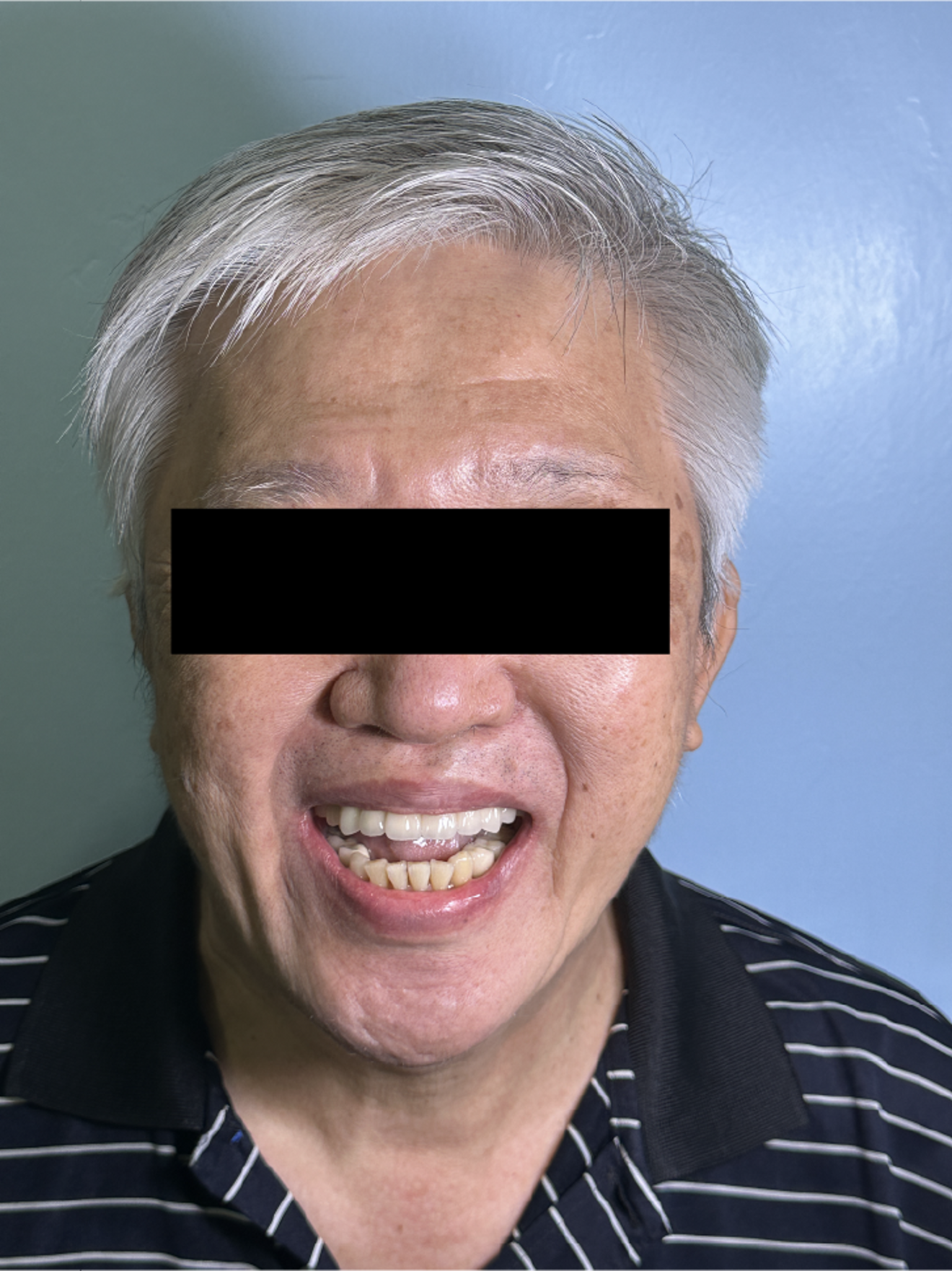 Fig. 3j: Post-treatment frontal smile view demonstrating improved  dental aesthetics and lip support.