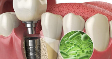 Study lays groundwork for improving success of implants