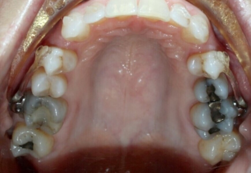 Fig. 19b: After six months of the Carriere Motion appliance and aligners. (a) Lateral view. (b) Occlusal view.