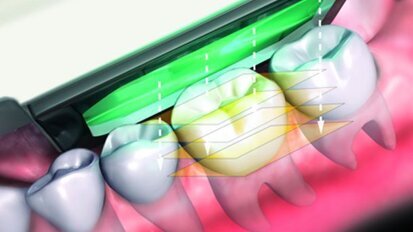 Intraorale Abformung mit der Kamera