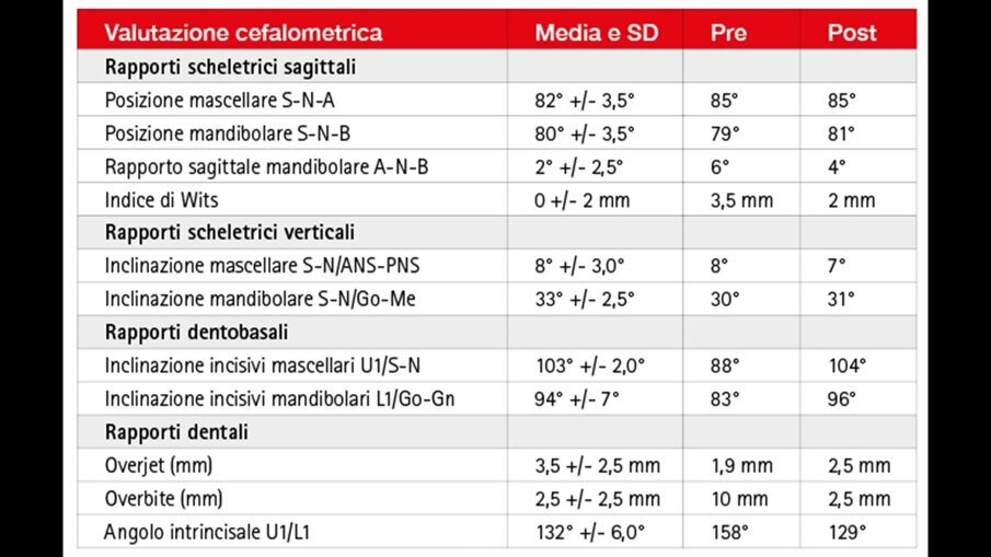 Tabella 1_Valutazione cefalometrica pre e post-trattamento.